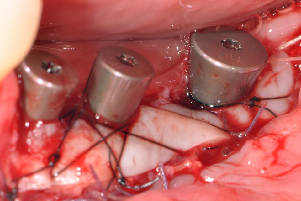 Fig. 4h: Free gingival graft was subsequently given after 6-month follow-up post-GBR-surgery