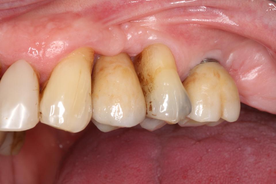 Fig. 19: Monolithic zirconia crowns made based on a digital impression. Selective pre-sintered staining gave a color gradient from cervical to incisal and subsequent glazing and staining gave identity to the teeth
