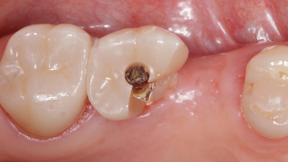 Fig. 10: Fatigue fracture of an implant-supported zirconia crown