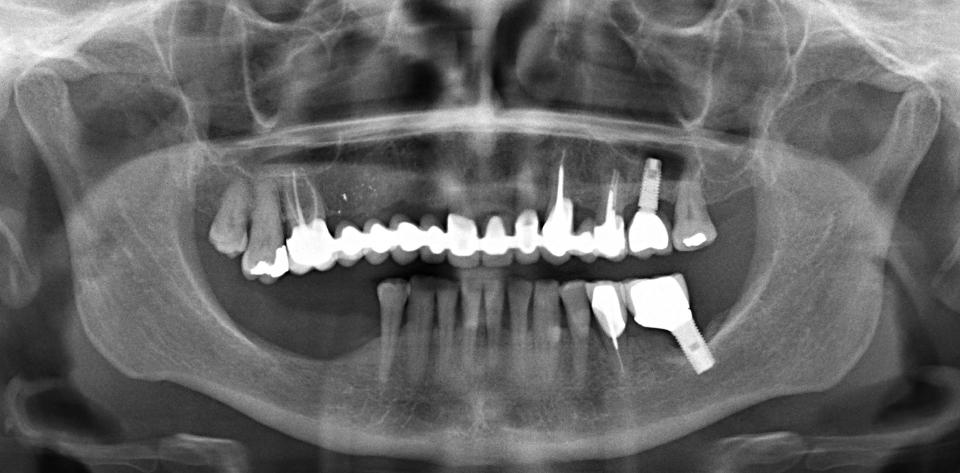 Fig. 3a: Preoperatory panoramic view, vertical deficiency on posterior mandible