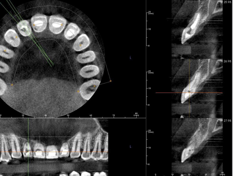 Fig. 5a: Patient 2, CBCT radiographs highlighting root resorption of teeth 11 and 12