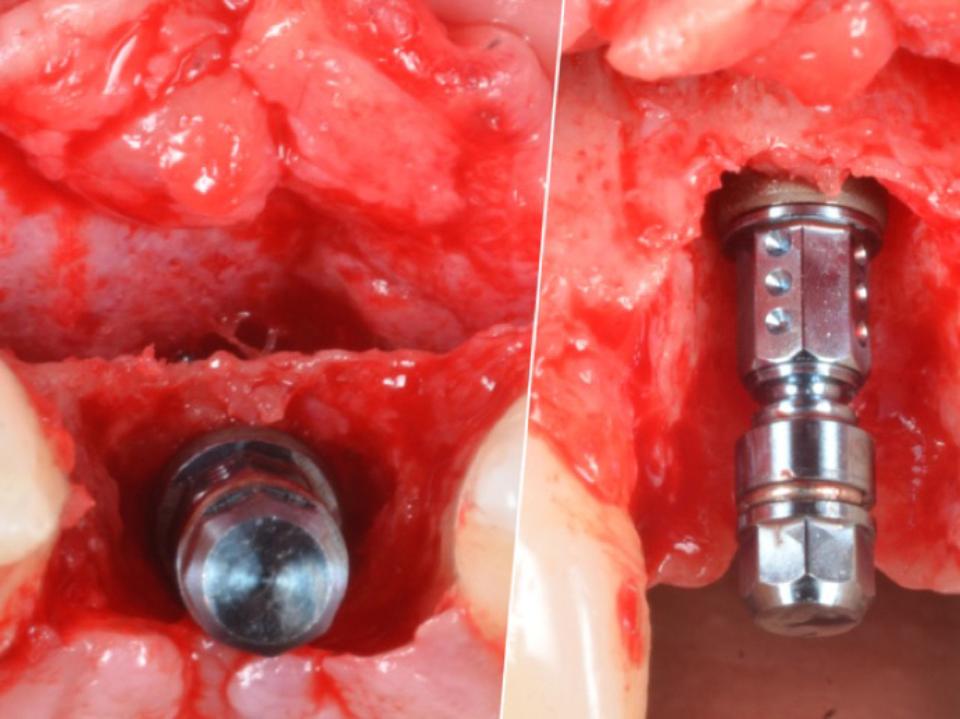 Fig. 13b: Early implant placement in the ideal three-dimensional position with simultaneous soft and hard tissue reconstruction leads to peri-implant health and satisfying esthetic outcomes