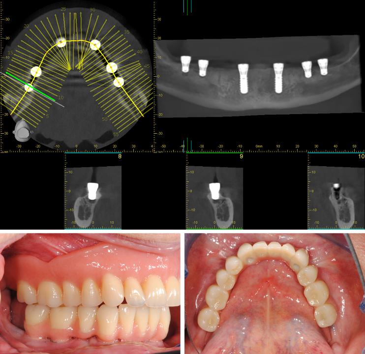 Figs 13a - c: Bone augmentation procedures can often be avoided by using the Straumann Pro Arch concept, even for fixed cross-arch prostheses. It is currently being investigated in a clinical study at the ZMK Bern, supported by the ITI Foundation 