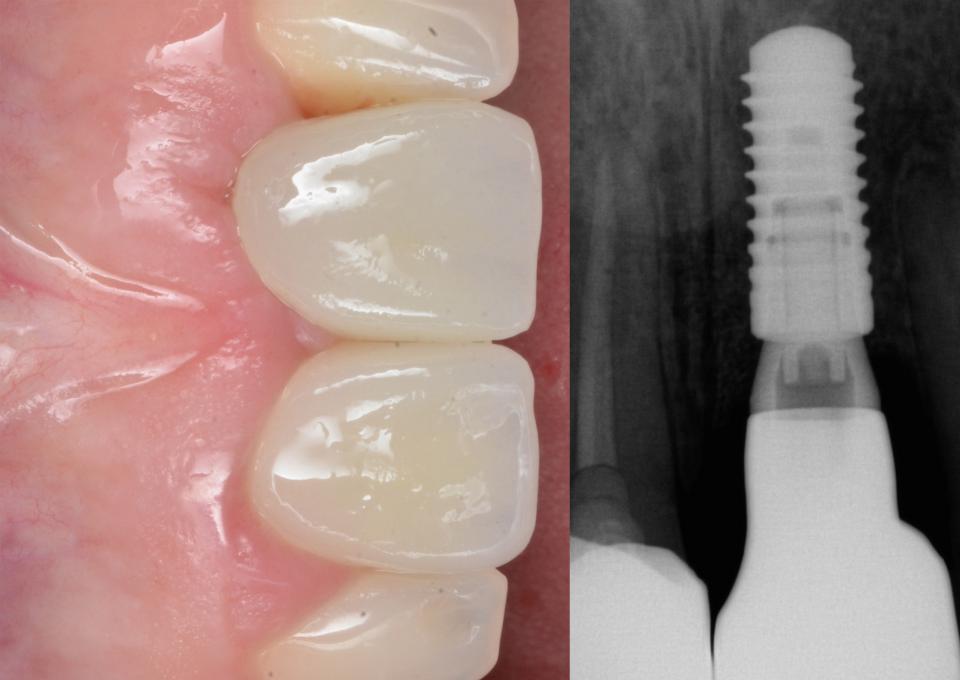 Fig. 13d: Early implant placement in the ideal three-dimensional position with simultaneous soft and hard tissue reconstruction leads to peri-implant health and satisfying esthetic outcomes