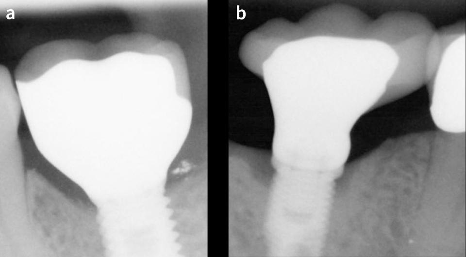 Fig. 9: Proper support of the ceramic veneering by the metal framework can increase the tolerance of the system to functional forces (a) and prevent veneering fractures. A deficient support (b) will predispose it to complications even within the anticipated spectrum of occlusal forces