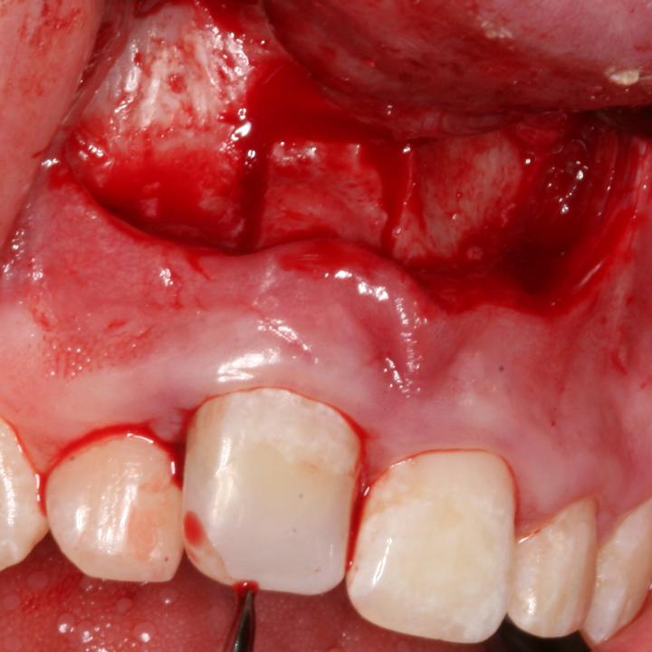 图7c: 三明治截骨术。在牙槽骨黏膜上切口，往根方剥离骨膜，在固连的11牙根周围截骨