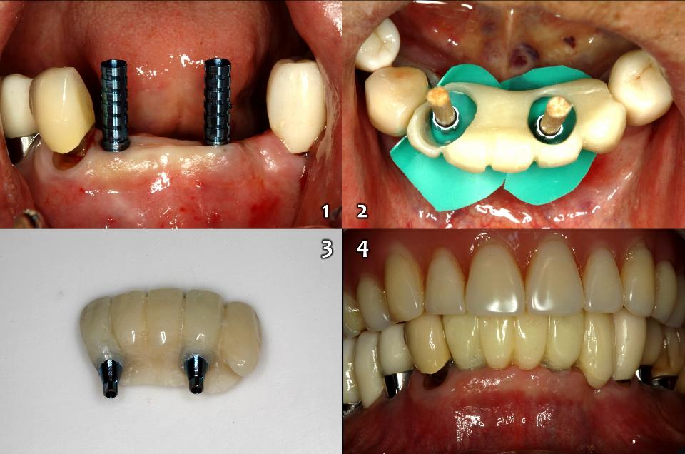 Fig. 10f: Temporary abutments (1) were placed on the implants (BLT, 2.9x12, NC, Roxolid, SLActive, Straumann), and immediate provisional restorations were inserted on the lower anterior edentulous ridge (2 - 3) with 15 Ncm fastening torque (4) immediately after implant surgery
