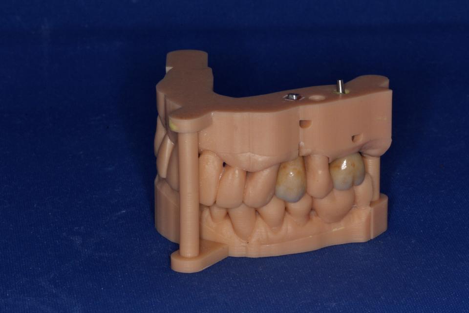 Fig. 17: Monolithic zirconia crowns made based on a digital impression. Selective pre-sintered staining gave a color gradient from cervical to incisal and subsequent glazing and staining gave identity to the teeth