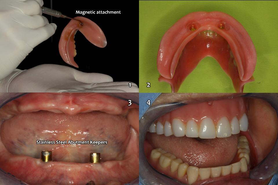 図14b: 第3優先の治療オプション （図5）。無歯上顎の従来型総義歯と、無歯下顎の、インプラント2本で保持されたオーバーデンチャーと、フレキシブルタイプの磁性アタッチメント （Magfit-SX800、愛知製鋼） は、もっとも安価で、患者にとって快適な治療オプションとして提供できる （1～4）。上顎および下顎の可撤式義歯は、2004年以降16年間、非常に良好に機能している。しかしながら2018年以降に手の障害、運動障害、活動障害が悪化し、独力ではうまく使用できないようになり、2021年 （当時93歳） に死去するまでの1年間は、静脈輸液で維持されていたため、上顎CDと下顎2インプラントOVDは余剰となった （図3）