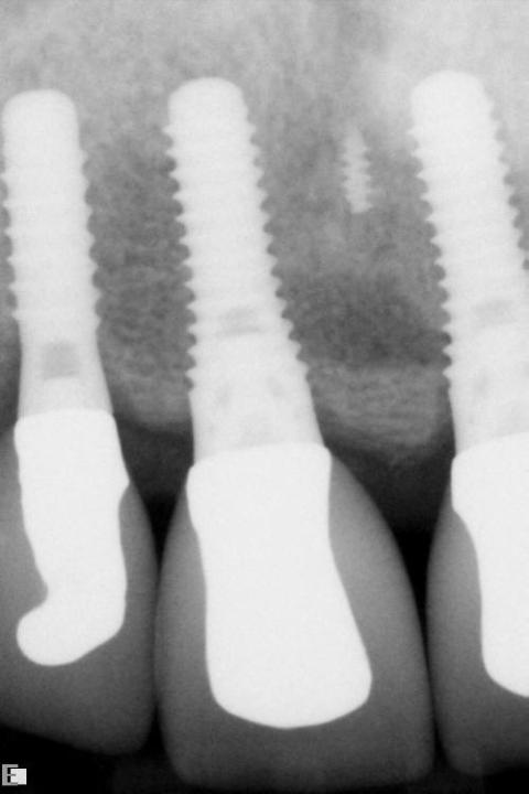 Fig. 4j-1: Periapical radiographs, 5 years after loading