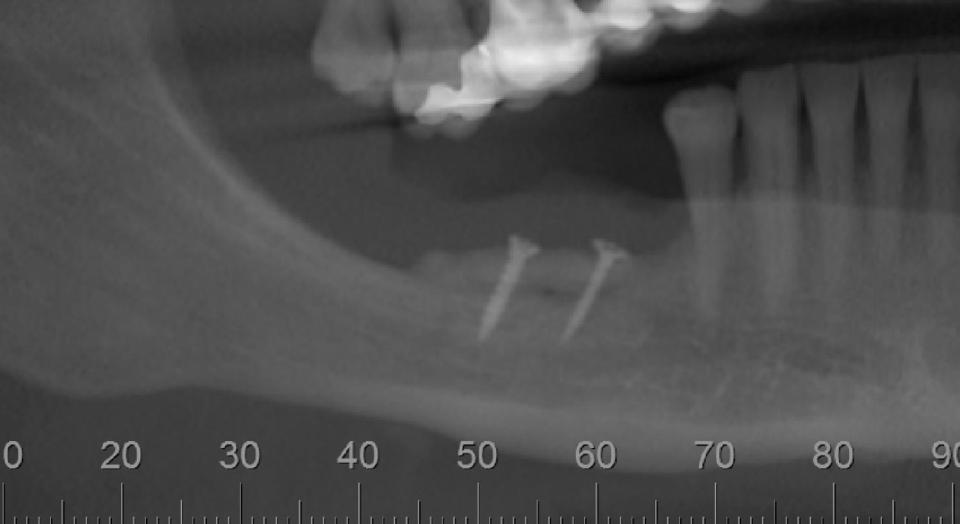 Fig. 3h: Postoperative radiograph showing graft integration 4 months after grafting