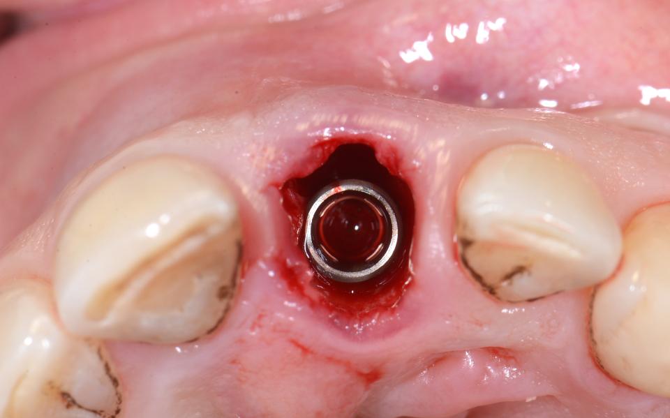 Fig. 5g: Occlusal view of the implant. There was a facial gap of 2 mm