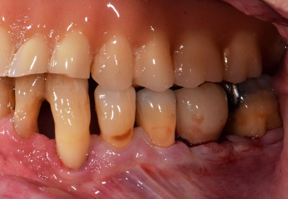 Fig. 6: Vista vestibular da restauração imediata instalada no dia da colocação imediata do implante no local do primeiro molar inferior esquerdo em um procedimento classificado como complexo e com evidência externa limitada ao Grupo C (cortesia de Samir Abou-Ayash).