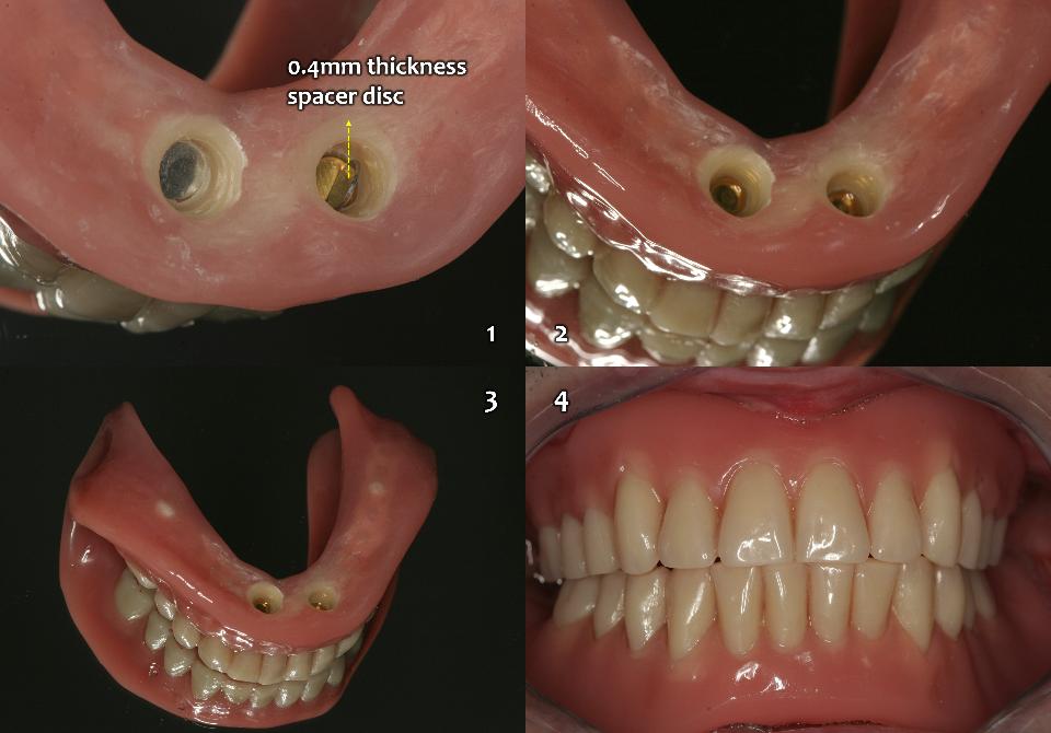 Fig. 15g: Completion of the lower magnetic IOVD as the 3rd priority in treatment options (Fig. 5). Conventional complete denture on upper edentulous jaw and 2-implant-retained overdenture for the lower edentulous jaw with the flexible type of magnetic attachment (Magfit-SX800, Aiichi Steel) can be provided as the cheapest and patient-friendly treatment option (1 - 4). The upper CD and lower magnetic IOVD are working very well