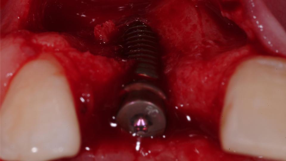 Fig. 9b: Colocación de implante tipo 2: Reborde alveolar reabsorbido