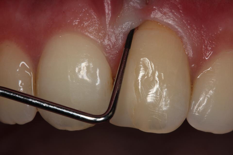 Fig. 2: Deep probing depth in the mid-facial area of tooth 21