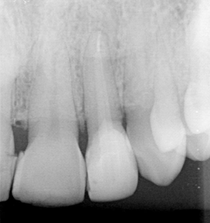 Fig. 2b: A periapical radiograph of the maxillary left lateral incisor