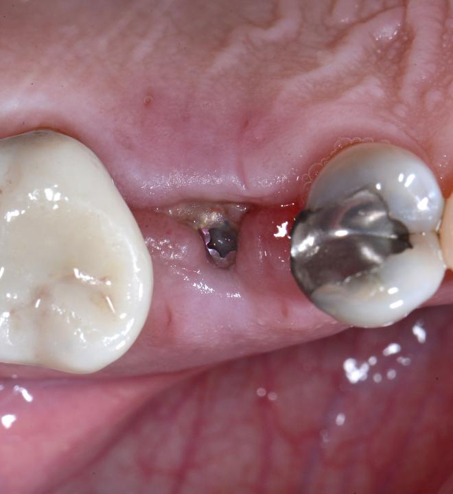 Fig. 6i: Post-operative occlusal view of the implant site 10 days later. Healing progressed uneventfully and restorative procedures commenced 10 weeks after implant placement (conventional loading)