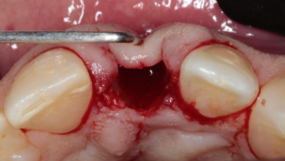 Abb. 3d: Minimalinvasives Verfahren zur lappenlosen Zahnextraktion – Ansicht von okklusal nach der Extraktion. Bei der Inspektion der Alveolenwände fällt ein deutlicher Knochendefekt auf, der eine Kontraindikation für die Fortsetzung des Typ-1a-Protokolls sein kann