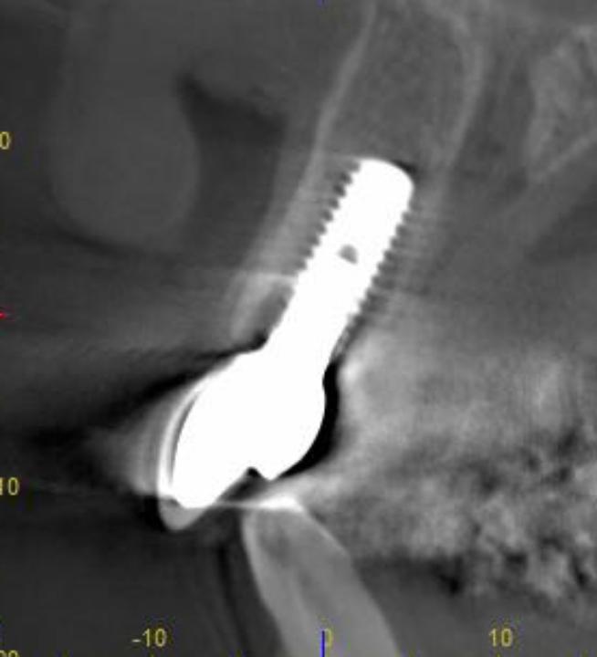 Fig. 5p: CBCT cross-sectional control taken 3 years after implant placement. This confirms the presence of an intact and thin facial bone wall