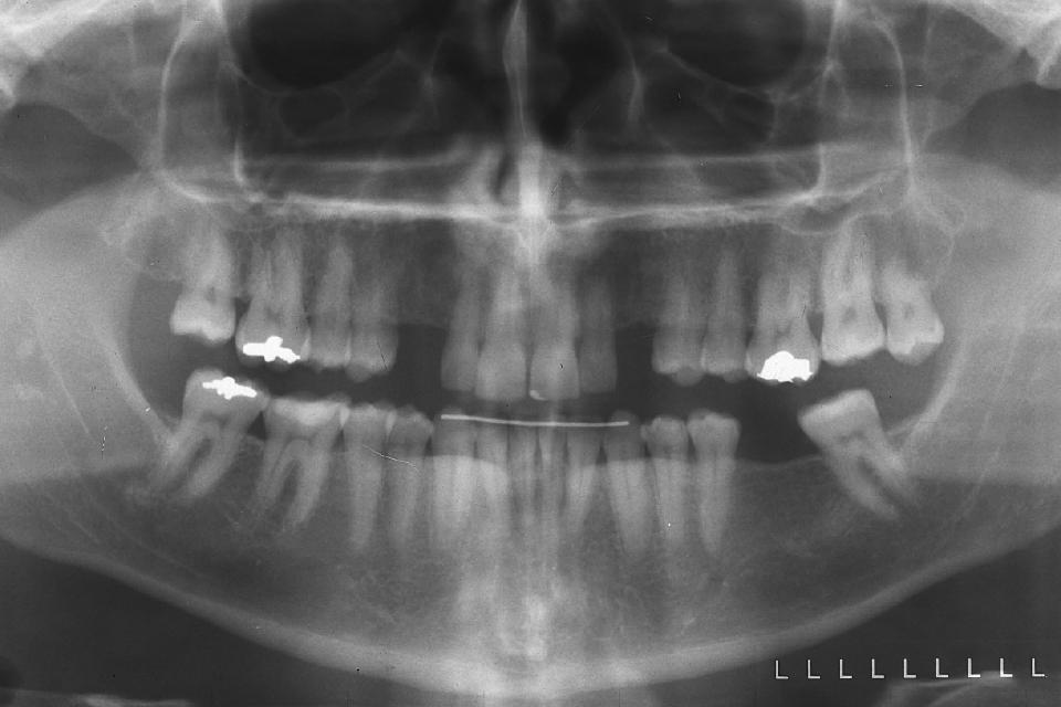 Fig. 2: Patient 1, panoramic radiograph