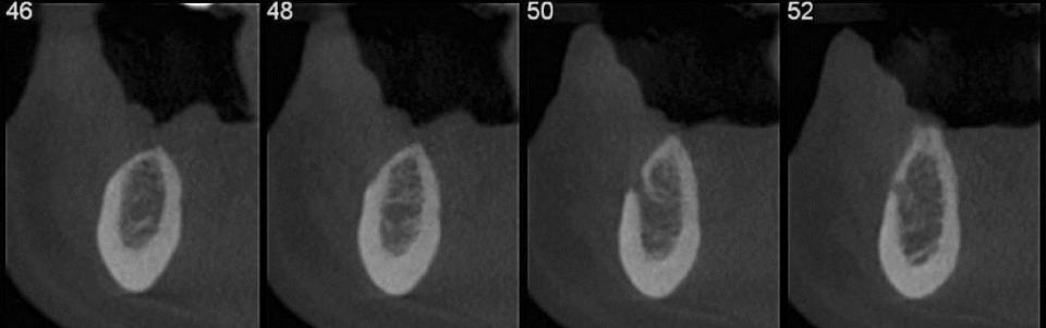 Fig. 3c: Preoperative CBCT showing posterior mandible deficiency