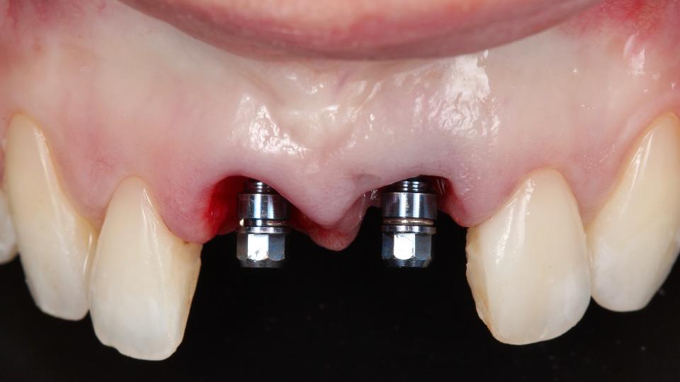 Fig. 5i: Uso del protocollo di chirurgia implantare statico-computerizzata completamente guidata per l'inserimento immediato degli impianti – impianti inseriti