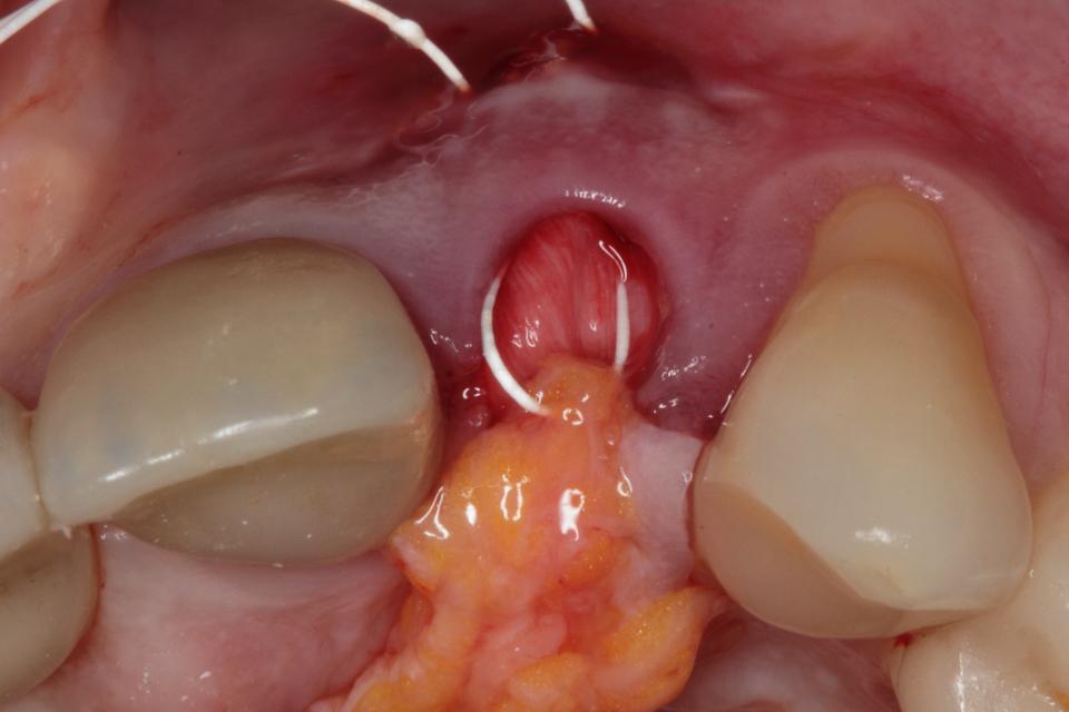 Fig. 48: A subepithelial connective tissue is pulled underneath the buccal soft tissue…