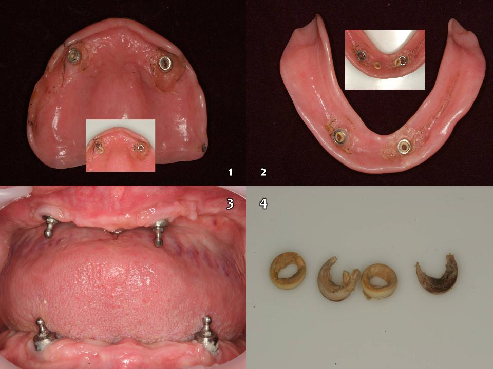 图. 17a: 也是一名来自牙科诊所的患者。其口内的IOVD是按扣式橡胶圈固位结构，已经戴用1年 (1、2)。按扣结构的金属部分已经磨损(3)。上下颌的固位橡皮圈已经因松动或损坏而不起作用。这些固位橡皮圈的使用时间不到一年(4)。取决于患者不同，有时需要每个月更换一次 
