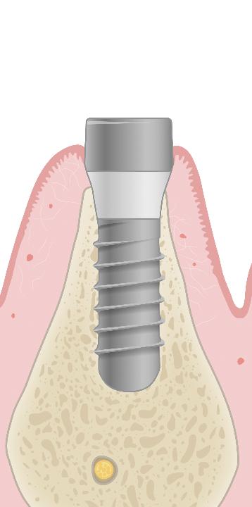 Fig. 5a: Implants placed with insufficient alveolar width may lead to avascular necrosis on the buccal aspect. This may lead to biofilm-mediated peri-implantitis
