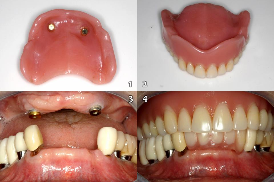 Fig. 10d: OVD maxilar superior sobre 2 implantes con retenedores magnéticos terminada. La paciente lleva una prótesis provisional tras la extracción de los 6 dientes anteriores mandibulares