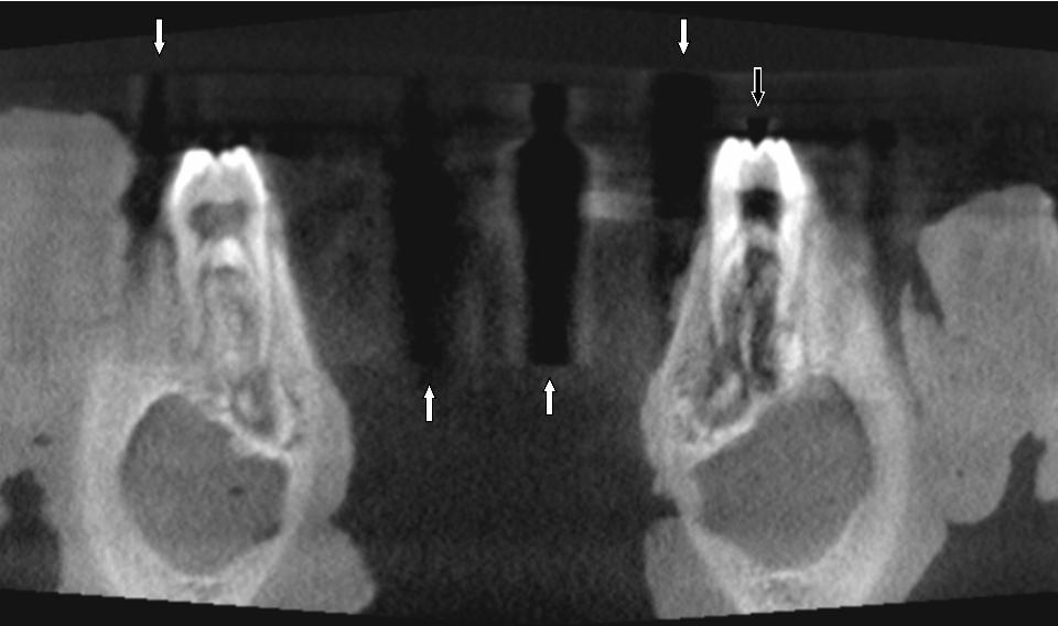 Fig. 3: Reconstruction frontale d’une mandibule de porc à partir d’images de tomographie à faisceau conique. Les flèches blanches indiquent la présence de bandes sombres en forme d’implants. La flèche noire indique une importante dégradation de l’image d’une molaire sur le trajet d’une bande sombre.