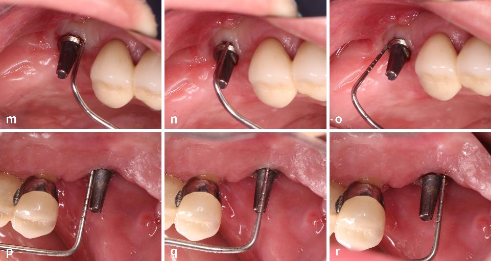 Abb. 3m–r: Bei der Kontrolle der GBR-Operation nach 1 Jahr ist ein Band aus keratinisierter Gingiva zu erkennen. An den Implantatoberflächen wurden umlaufend die Sondiertiefen überprüft, die jeweils < 4 mm betrugen; eine Blutung beim Sondieren trat nicht auf. Die bisherige implantatgetragene Prothese wurde wieder einzementiert