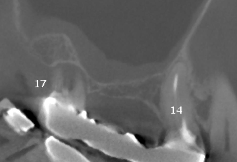 Fig. 2b: The panoramic view of the CBCT shows a reduced ridge height in area 15 and 16. The Schneiderian membrane is slightly thickened. There is no bone septum visible
