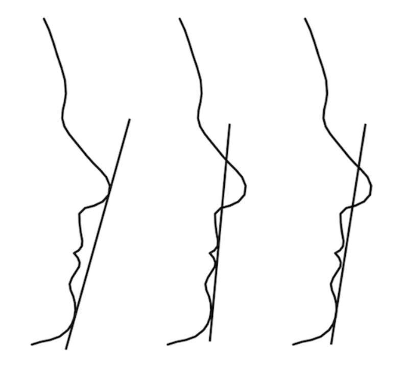 图1: 正畸诊断中常用的三条面部参考线，用于描述嘴唇相对于颏部和/或鼻子的位置。
左：E线，连接鼻尖点和颏前点。在正常的软组织轮廓中，下唇位于E线后4 (+/- 3)mm。
中：H线，是颏前点与上唇最前点的切线。在正中颌位，H线和FH之间的夹角在7 - 14度之间。
右：连接颏前点和鼻小柱中点的S线。侧貌平衡良好时，上下唇应该接触S线。
(经作者许可，转载自http://urn.fi/urn:isbn:9789526231945)