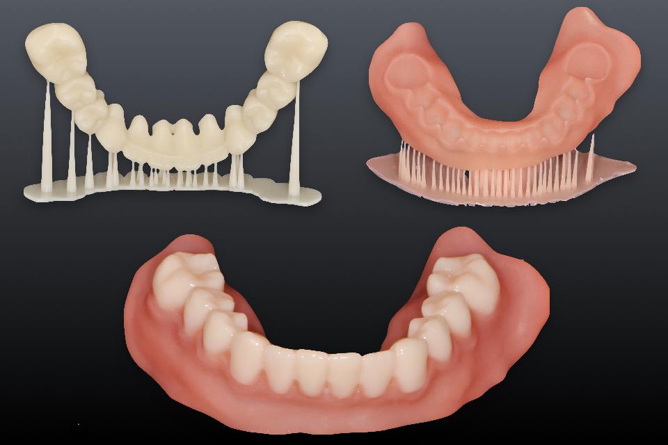 Fig. 37: 3D printed interim denture with a desktop DLP printer. Although desktop SLA or DLP printers are convenient for in-office production, one major limitation is that only one material (in color or stiffness) can be used in a single print job. When different materials are desired (such as pink and white resin in this instance), two separate prints and post-printing assembly are needed