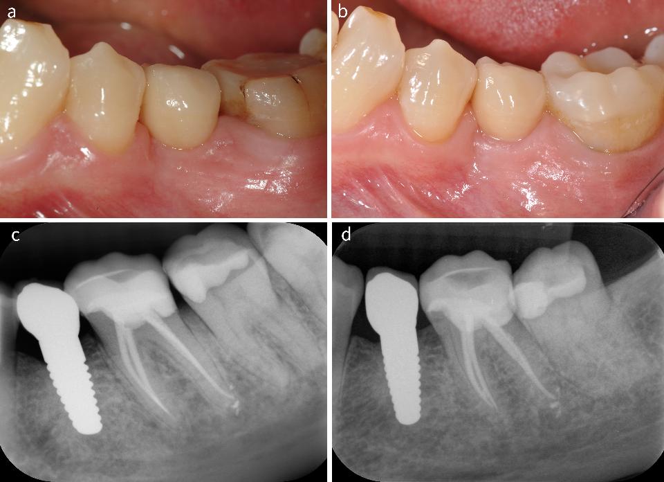 Fig. 1: Clinical images of a two-piece zirconia implant supporting a single crown (a) after 1 year of functional loading, and (b) after 5 years. Radiographic images (c) after 1 year, and (d) 5 years of functional loading