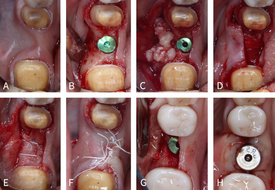 Fig. 7: Caso regenerado com osso pegajoso criado com enxerto de osso alógeno particulado utilizando FRP sólida e líquida. (A) Vista oclusal de um sítio edêntulo #19  com deficiência de crista horizontal. (B) Implante cônico BioHorizons de 4,6 x 10,5 mm com corticotomias na superfície vestibular da crista. (C) Um osso composto pegajoso foi compactado na superfície vestibular da crista utilizando enxerto de osso alógeno particulado misturado com FRP sólida e líquida. (D) Membrana de colágeno reticulado foi colocada sobre o material do enxerto. (E) Uma membrana de FRP sólida foi colocada sobre a membrana de colágeno e fixada com uma sutura de colchoeiro horizontal. (F) Fechamento de retalho sem tensão utilizando suturas de ePTFE. (G) Reflexão de retalho de espessura total 5 meses após a operação. (H) Colocação do pilar de cicatrização e sutura final. Observe o aumento da largura da crista quando comparado à fotografia pré-operatória original. (Caso realizado pelo Dr. Nathan Estrin).