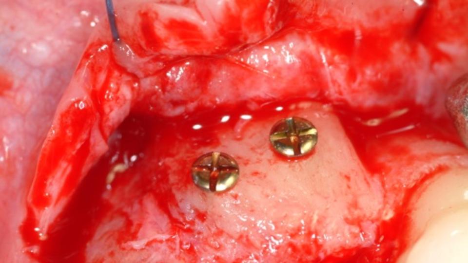 Fig. 11b: Greffe en bloc + pose d'un implant de type 4 : Cicatrisation idéale de la crête alvéolaire après une greffe osseuse en bloc.