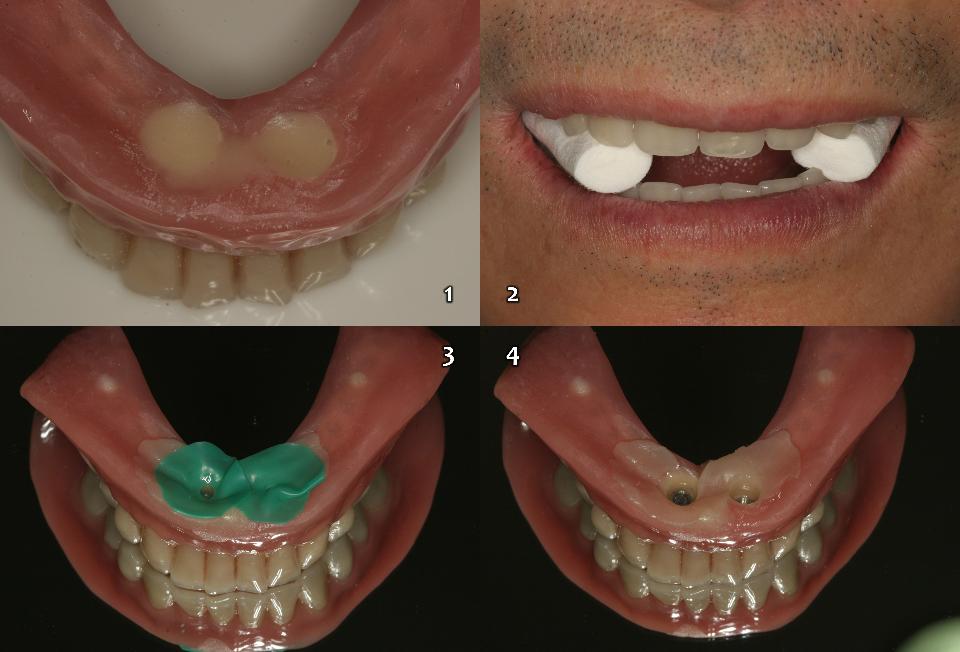 図15f: フレキシブルタイプの磁性アタッチメント （Magfit-SX800、愛知製鋼） を義歯に接着。1：セルフキュア型レジンを混合し、ハウジングに充填する。 2：口内に上顎・下顎義歯を入れ、臼歯部の義歯の上にコットンロールを当てて顎の中心位置に配置し、患者に噛ませて、アクリルレジンを完全に硬化させる。3～4：アクリルレジンが完全に硬化したら、義歯を口から取り出す