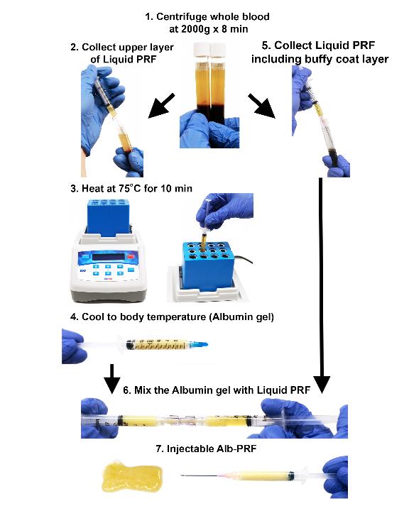 Fig. 11: Demonstração clínica passo a passo para a produção de e-FRP: (A) Punção venosa e coleta de sangue. (B) Centrifugação. (C) Material necessário para a produção de e-FRP (seringas Luer-lock/caps/luer-lock mixer). (D) Bio-Heat, dispositivo médico para aquecer o soro + plasma pobre em plaquetas (PPP). Observe que a máquina deve ser pré-aquecida antes de seu uso. (E) Após centrifugação, coleta do soro mais PPP. (F) Introdução do PPP no Bio-Heat a 75°C (10 minutos). (G) A camada rica em plaquetas restante é mantida no dispositivo Bio-Cool para estender o tempo de coagulação. (H) Após 10 minutos, coleta da regiãoFRP líquida + Buffy Coat. (I) Após 10 minutos, diferenças clínicas na cor são observadas entre a FRP líquida (superior) e o gel de albumina. (J, K) Um dispositivo misturador luer-lock é conectado à FRP líquida e ao gel de albumina. (L, M) Mistura da FRP líquida e do gel de albumina para frente e para trás para criar e-FRP. (N) e-FRP pronta para uso. Observe a capacidade de injetar de uma seringa após mistura adequada. (Reimpresso de Davies & Miron 2020).