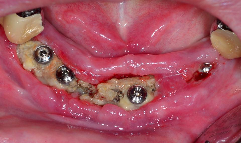 Fig. 14c: Immagine clinica di osso necrotico esposto e tessuti molli perimplantari infiammati intorno agli impianti dentali bone level