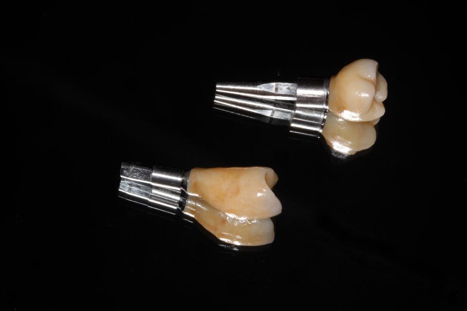 Fig. 18: Monolithic zirconia crowns made based on a digital impression. Selective pre-sintered staining gave a color gradient from cervical to incisal and subsequent glazing and staining gave identity to the teeth