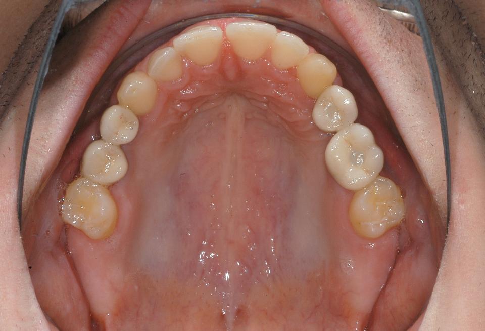 Fig. 6b: Implant-supported prosthetic rehabilitation of the patient: Occlusal maxillary view