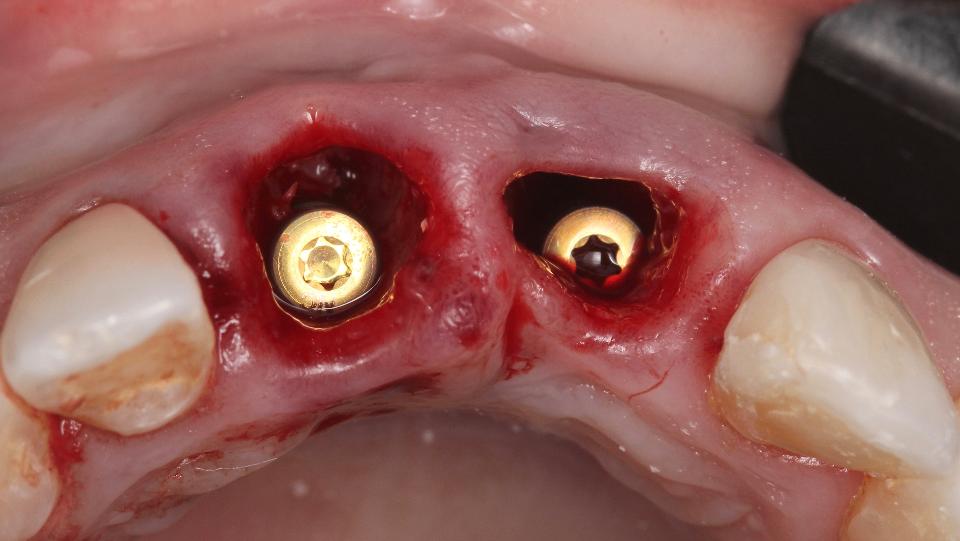 Abb. 6c: Typ-1a-Protokoll – Ansicht von okklusal nach dem Setzen der Implantate