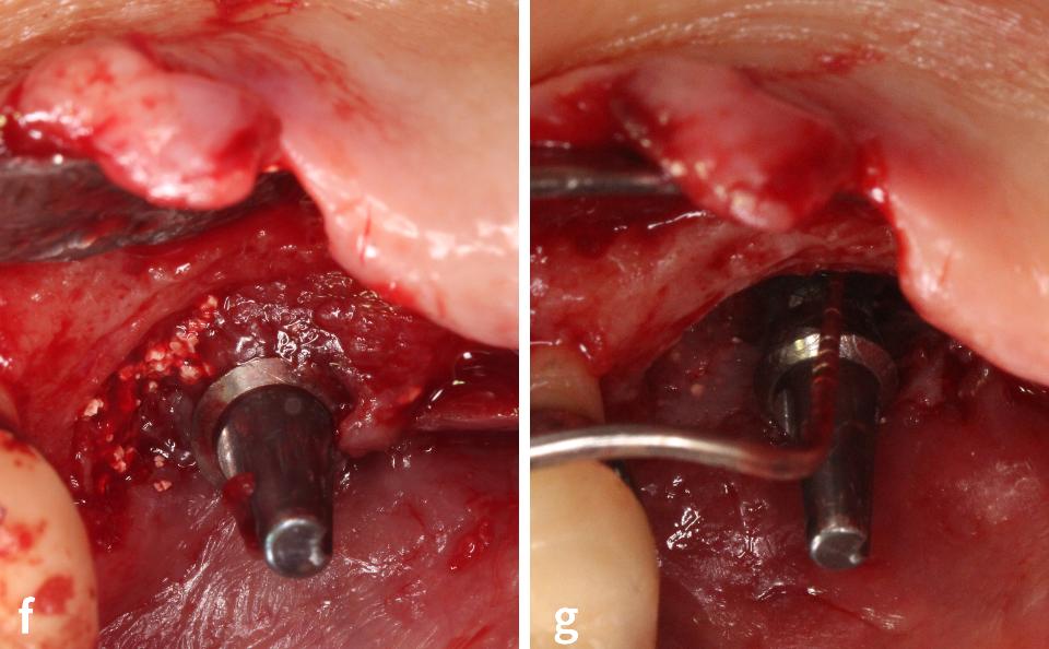 Fig. 3f – g: Before (f) and after (g) the removal of the unintegrated graft-like granule and granulomatous tissue in palatal view