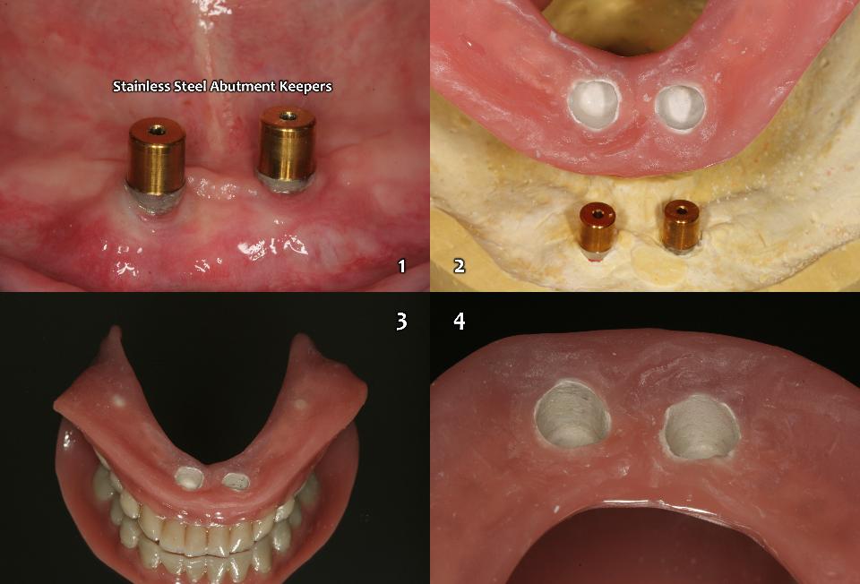 図15d: 磁性アタッチメントを接着する前の、ステンレススチール製アバットメントキーパーと下顎義歯の準備。1～2： ステンレススチール製アバットメントキーパー （Magfit-SX800、単独 & フラットトップのアバットメントキーパー、愛知製鋼）。 3～4： 磁性アタッチメントを固定する前の、PEEK強化フレームワークを含んだ下顎義歯