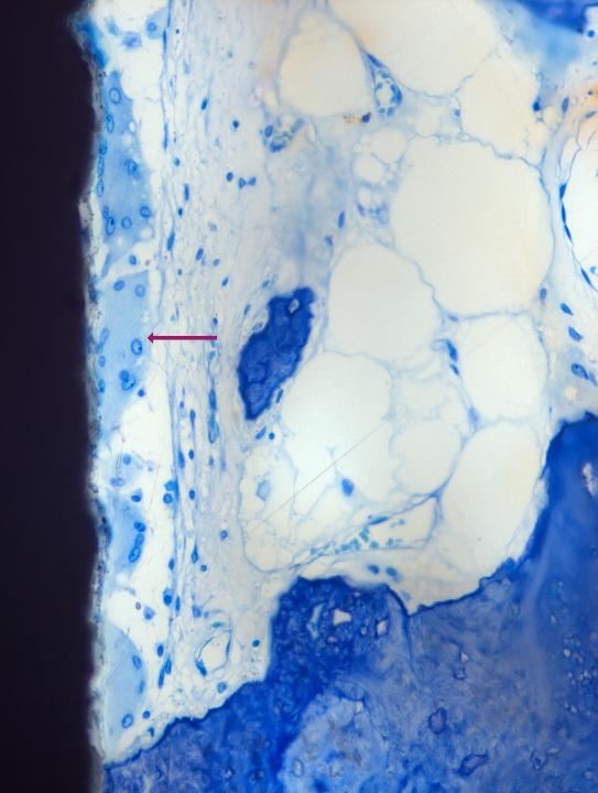 Fig. 7: Multinucleated giant cells (arrow) on a micro-rough Ti6Al4V implant surface (from Saulacic et al. 2012 with permission)