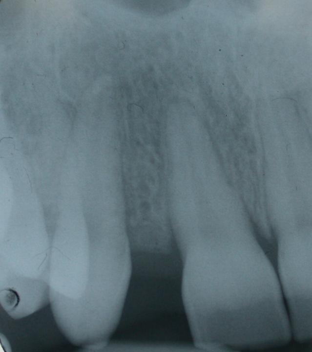 图2: x线片显示牙根间距不能植入种植体，这说明牙根监测的重要性