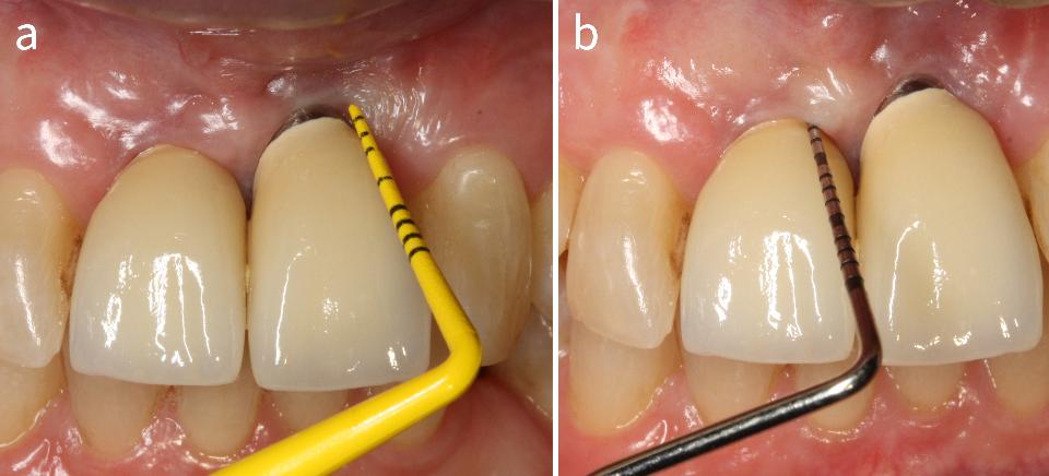 图4: 使用手动牙周探针(a:塑料探针，b:金属探针)，轻柔探诊(约0.2N)来评估BOP的存在与否，并监测PD的变化，以及种植体周围黏膜边缘水平的变化